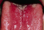 舌头发白：艾滋病初期症状的舌头症状